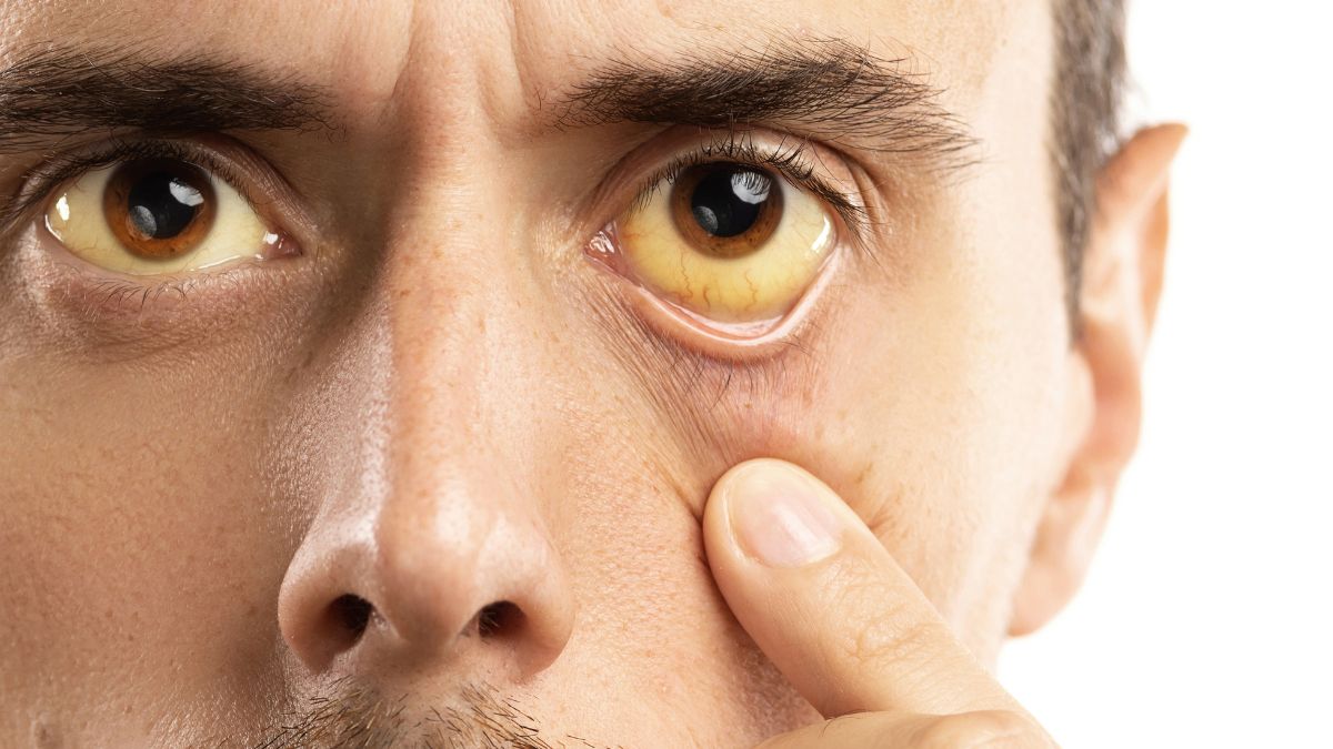 Pri hepatitíde býva typický príznak žlté sfarbenie očných bielkov, kože a slizníc. Zdroj foto: Canva Žlté sfarbenie očných bielkov